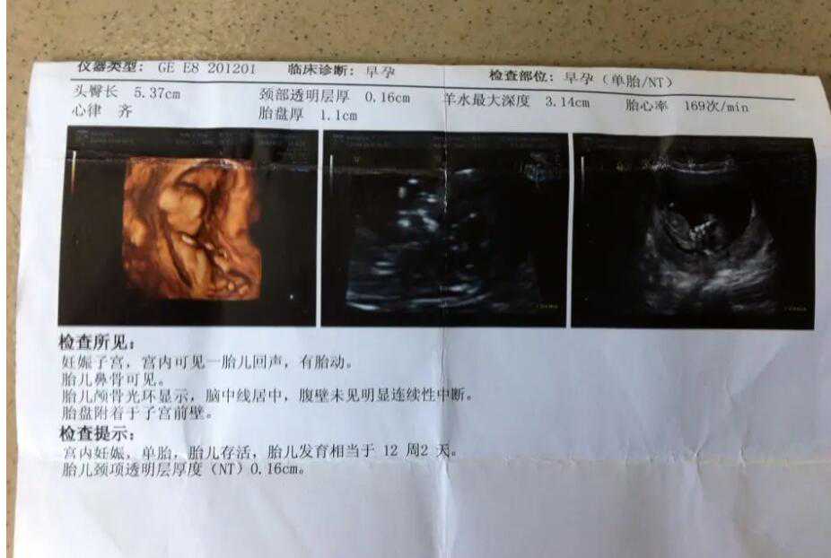 广州助孕医院服务 2022广州哪家医院可以做第三代试管婴儿? ‘四维胎心率怎样
