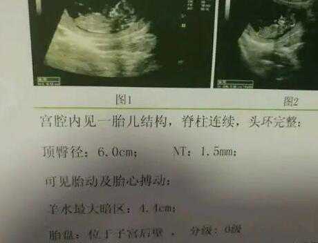 广州医院供精供卵流程 广州中山医院试管费用明细： ‘孕囊多大看男女性别’